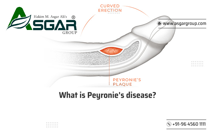  What Is Peyronie’s Disease?